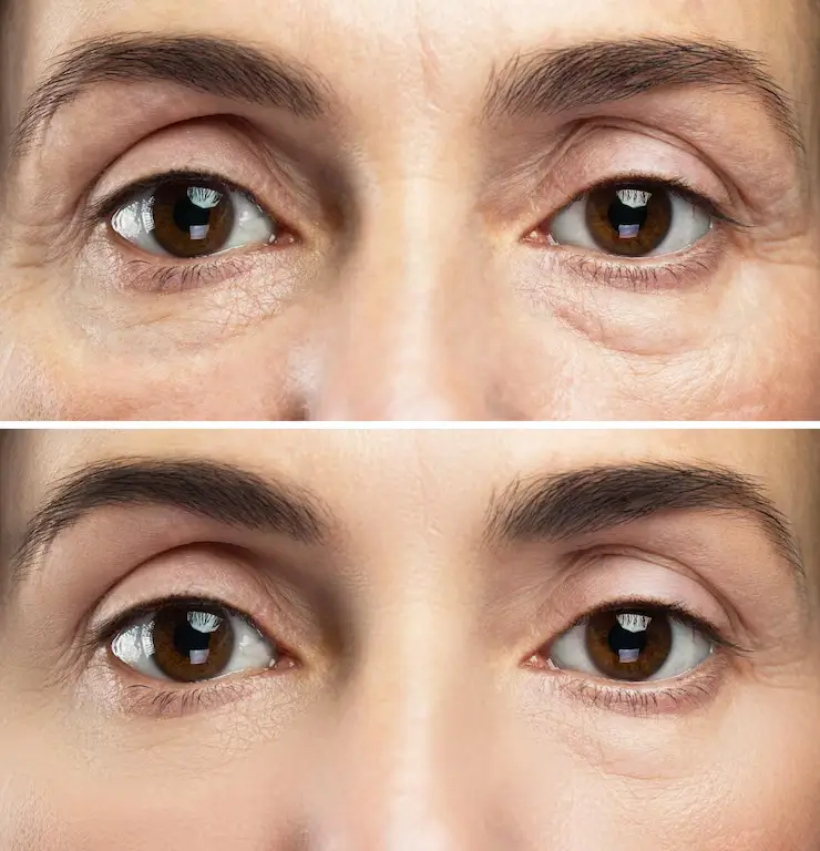 Luminous skin resurfacing